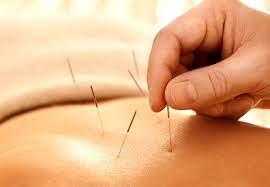 What You Should Know About Acupuncture